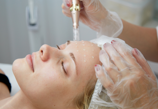 microneedling near me services