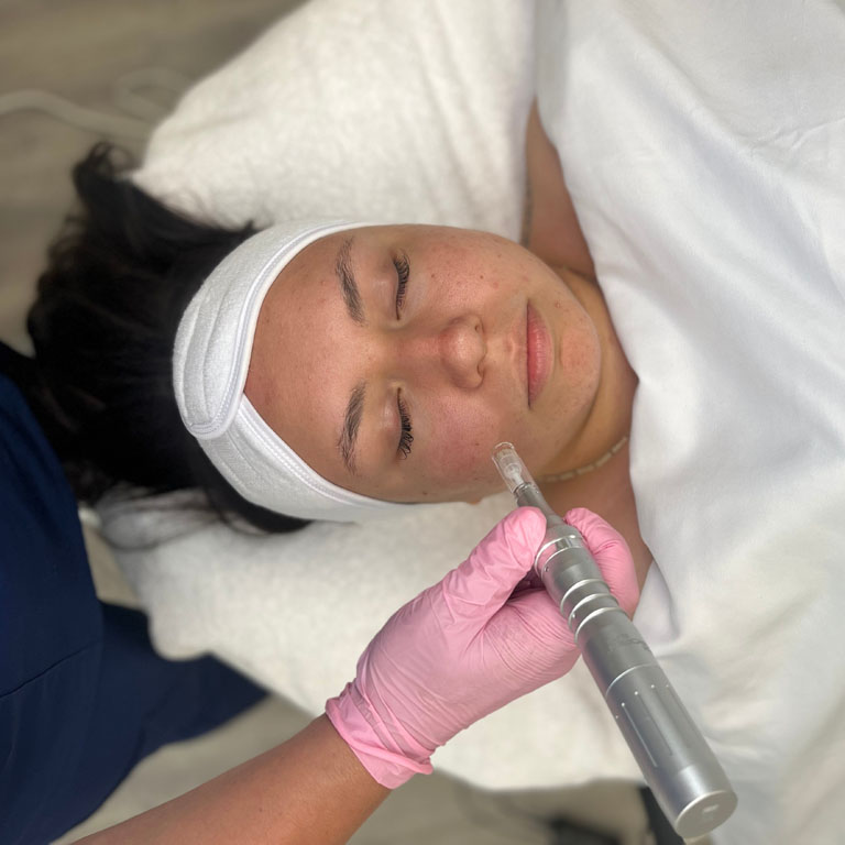 microneedling